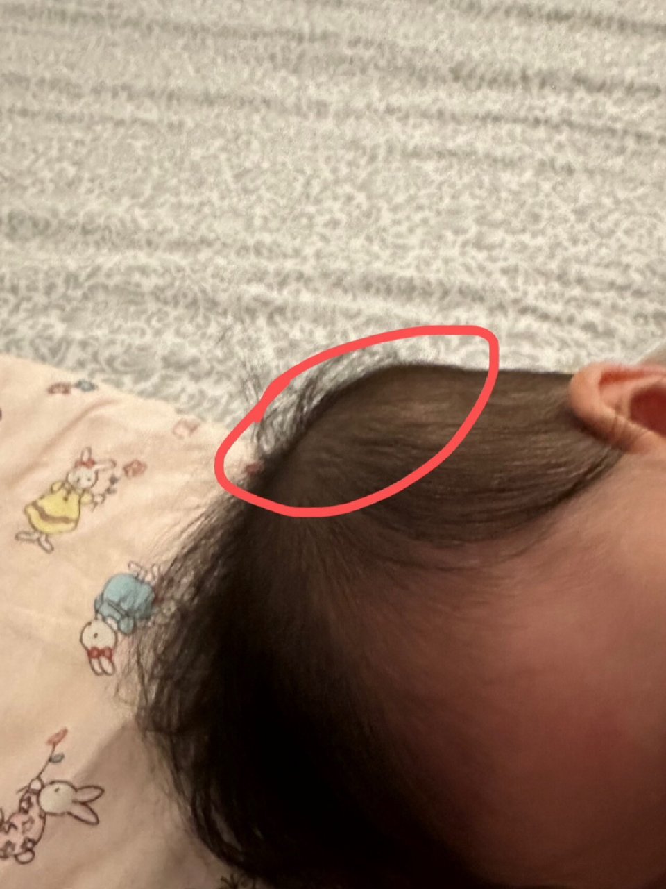 宝宝摔下床 后脑勺的位置凹了 如图 在大床摔到木地板上 左边耳朵上的