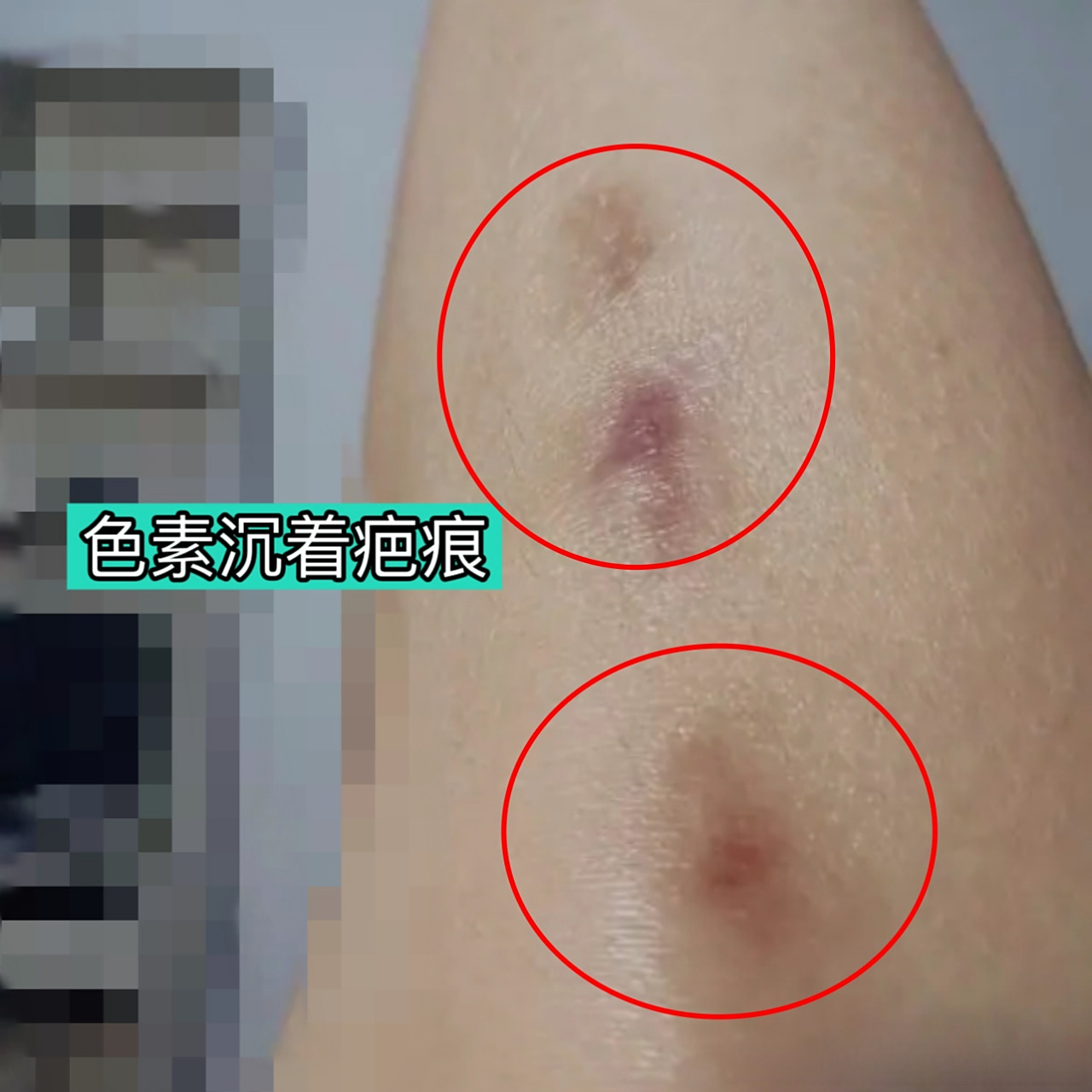 伤口愈合以后,有的疤痕会出现发黑的现象.