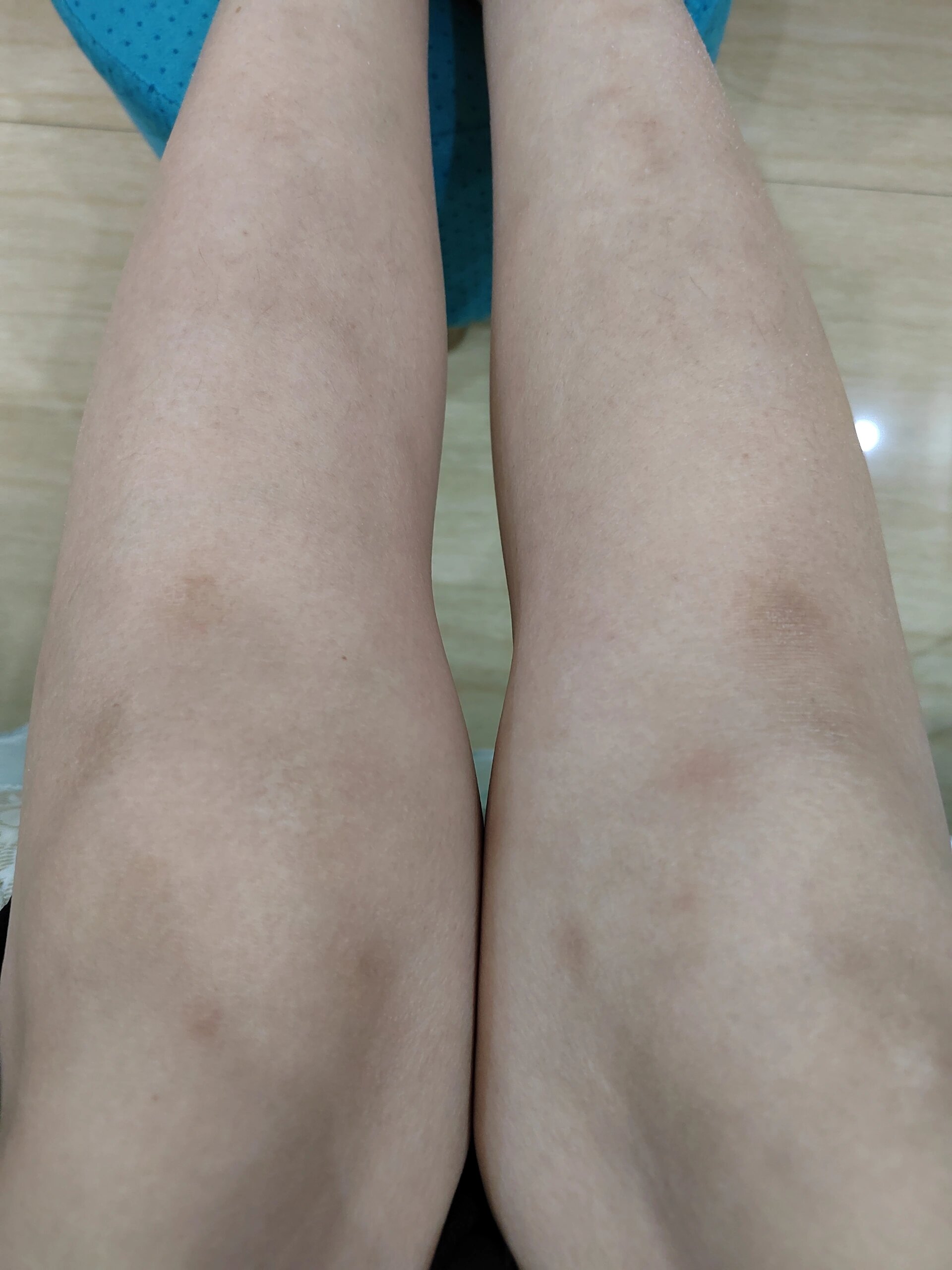 结节性红斑