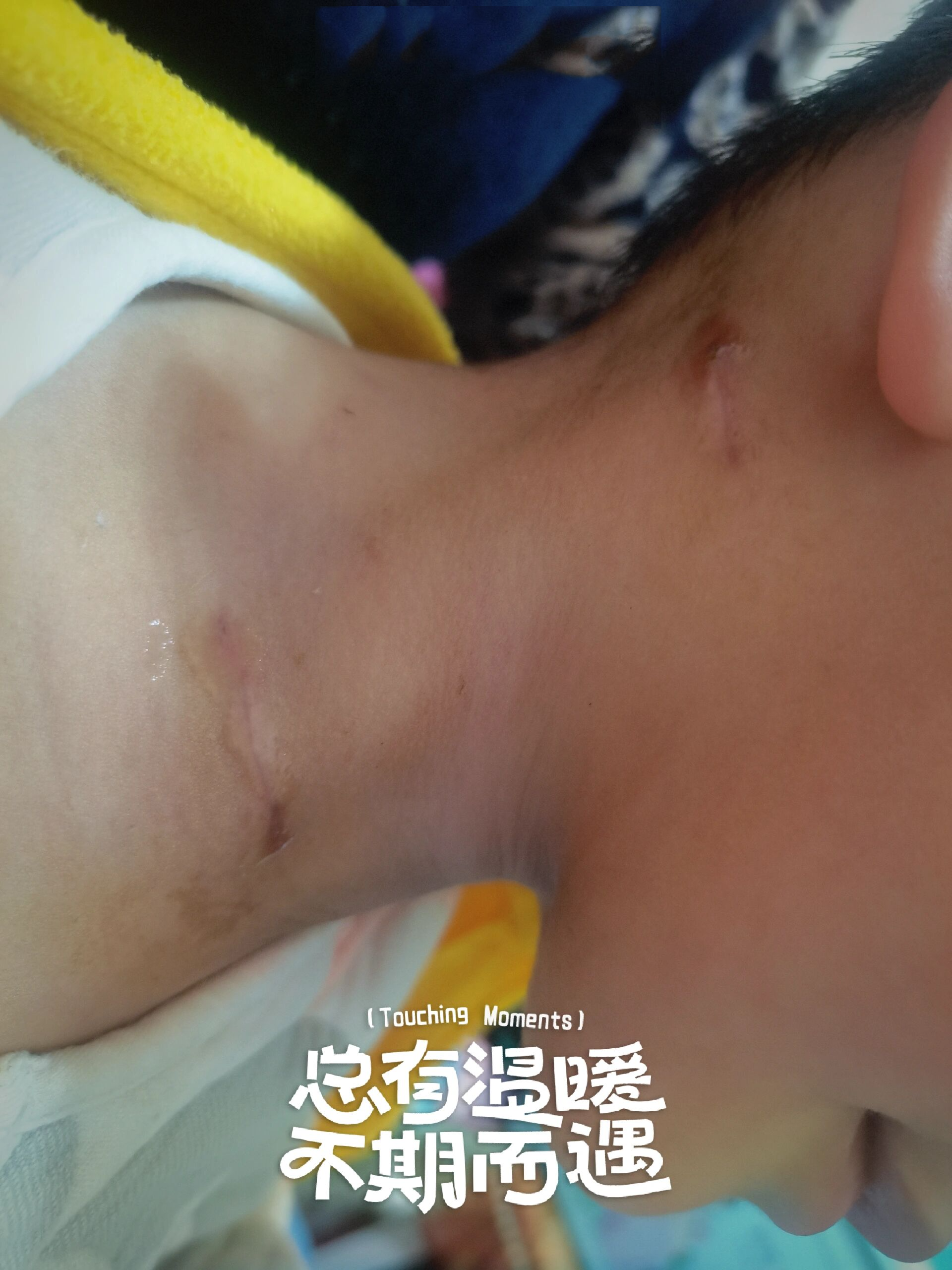宝宝是属于斜颈较严重的,手术有两个创口,还是比较长的.