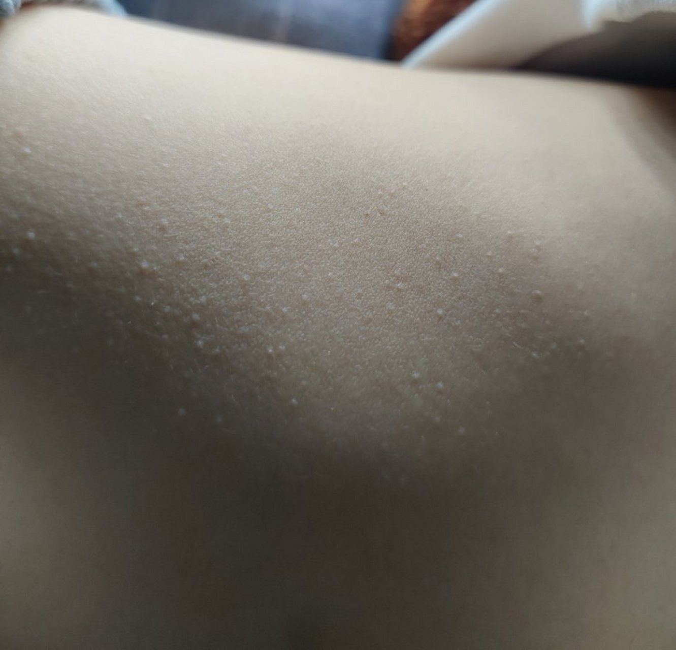 儿童四肢和躯干部位的密密麻麻丘疹,光泽苔藓#过敏