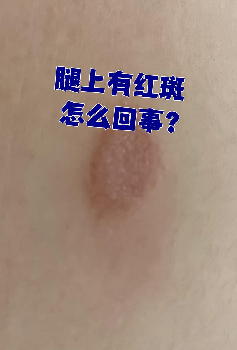 腿上出现红斑,最常见的原因是过敏或体癣