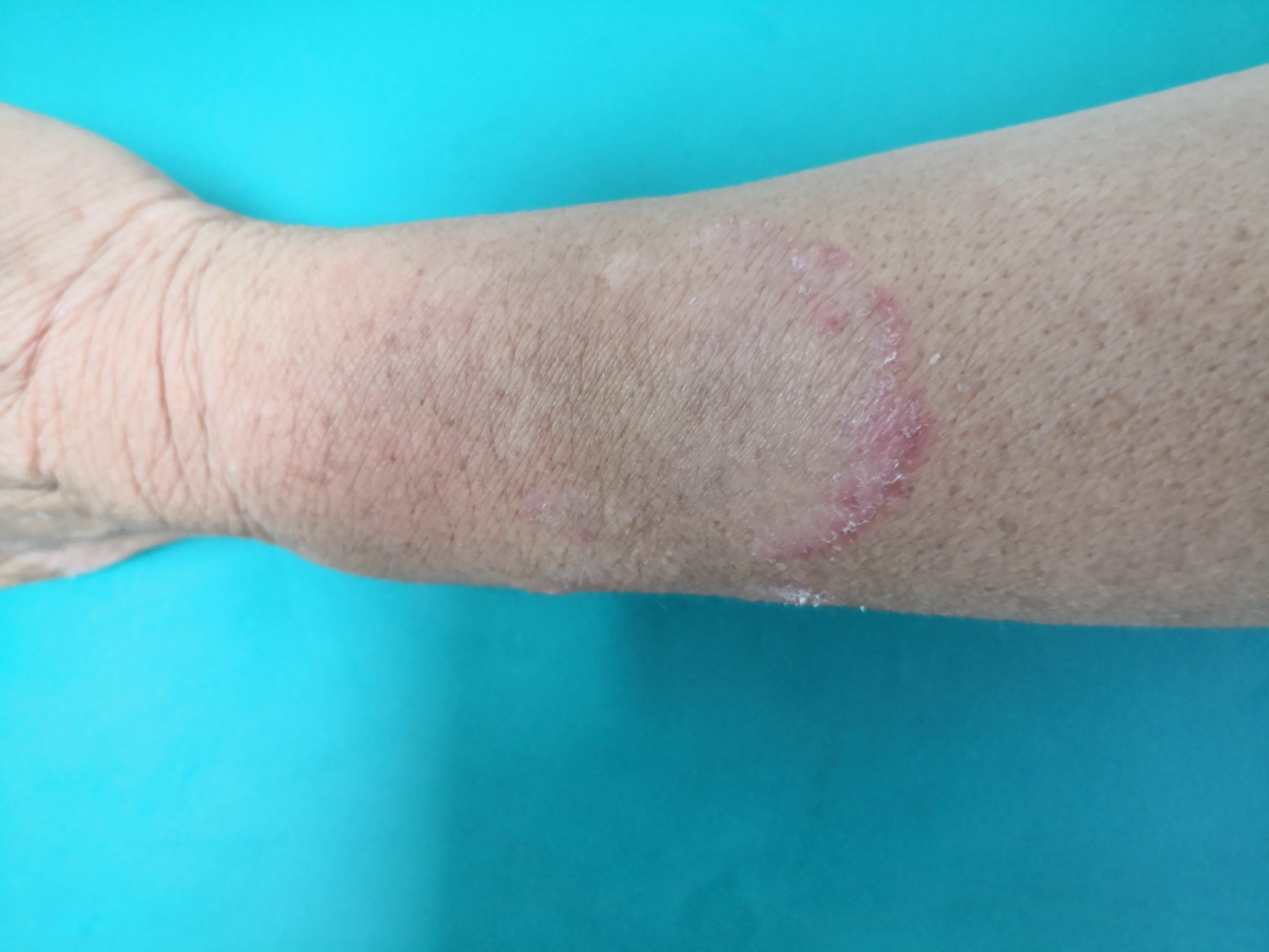 左侧手臂大片丘疹斑块,边界清楚真菌镜检阳性,诊断体癣