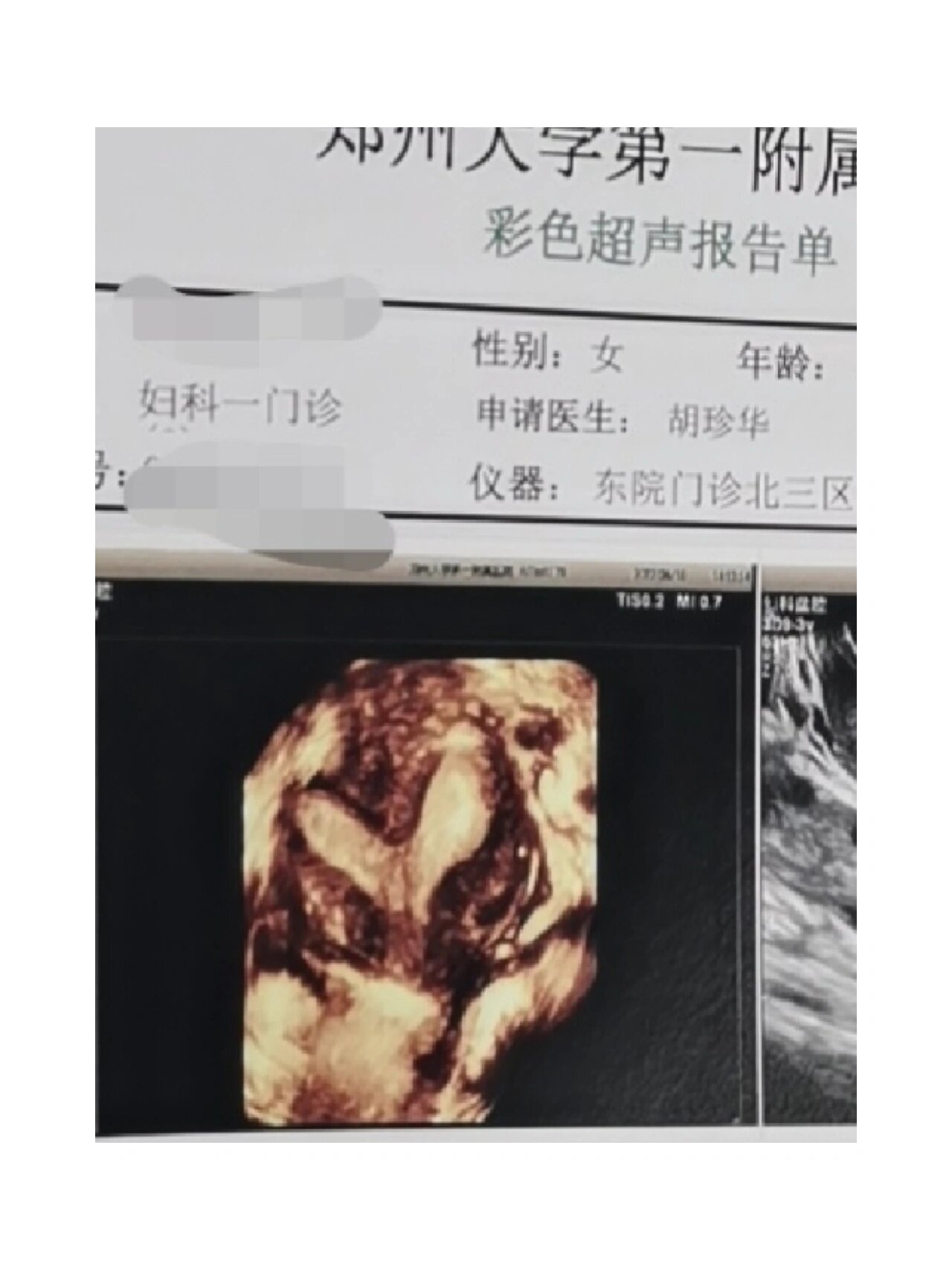 子宫纵膈手术全记录1 这几天难受的要死,终于有心情记录下我的子宫纵