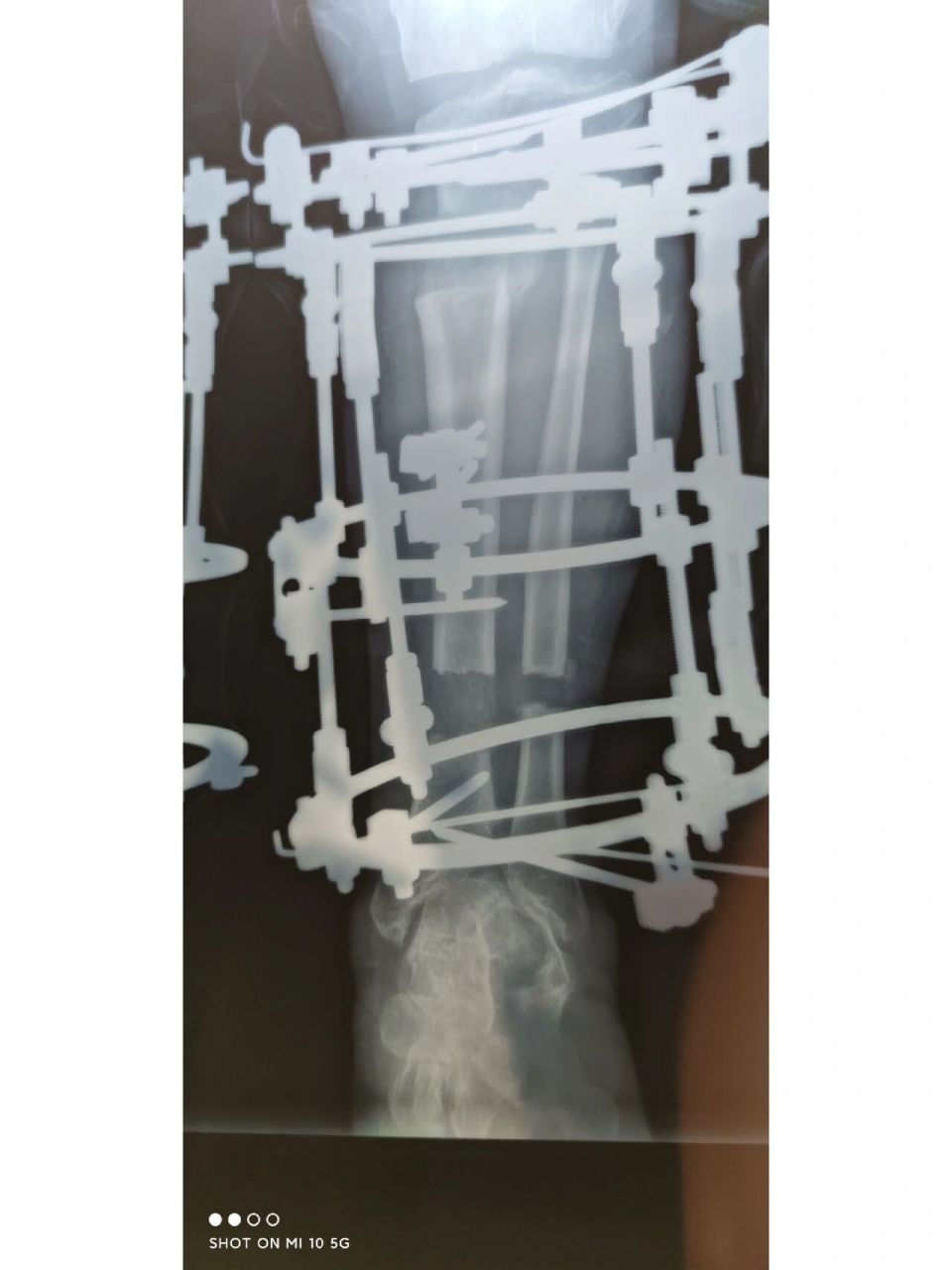 锁骨骨痂图片图片