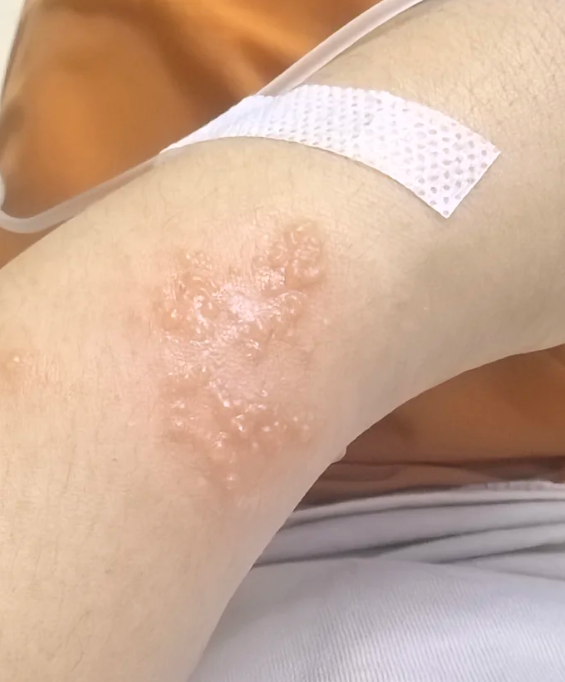 手臂上突然出现很多小水泡,常见原因有烫伤,带状疱疹或疱病