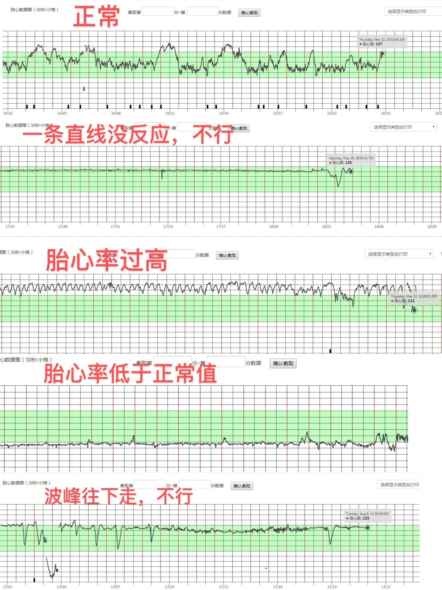 一张图教会你怎么看胎监图,孕晚期不焦虑!