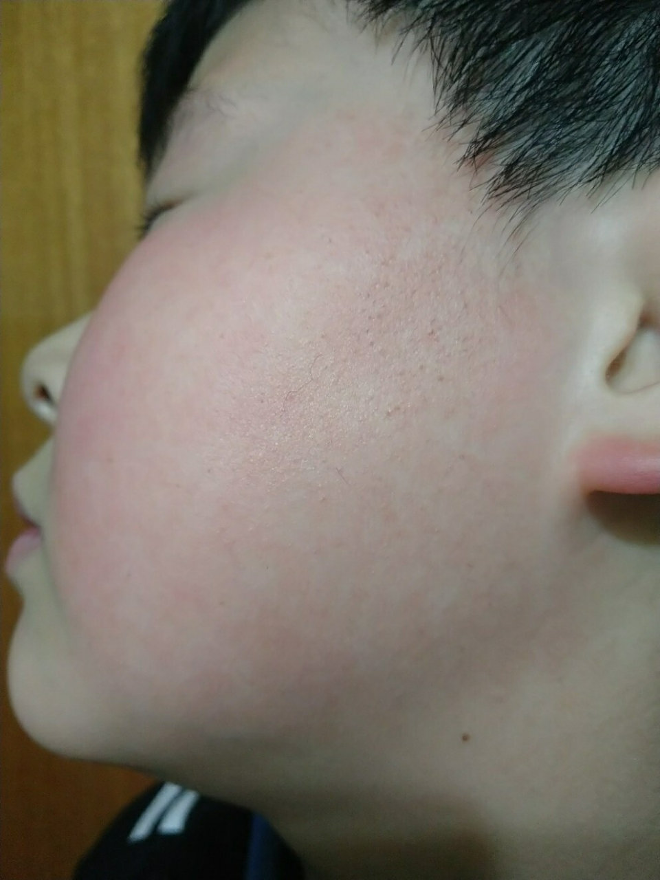 毛周角化(脸发红型)治疗记录第四天 2021年2月13日 虽然没有抱很快