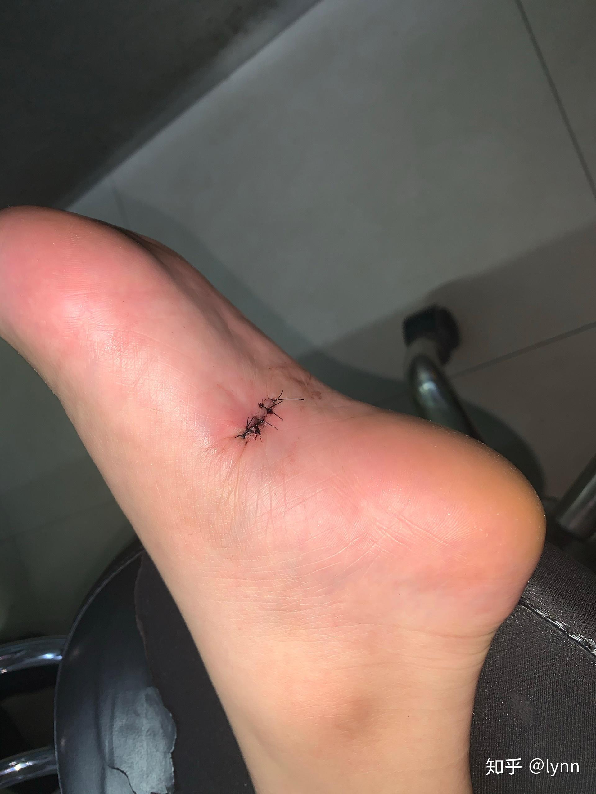 手术切脚底痣是怎么样的体验