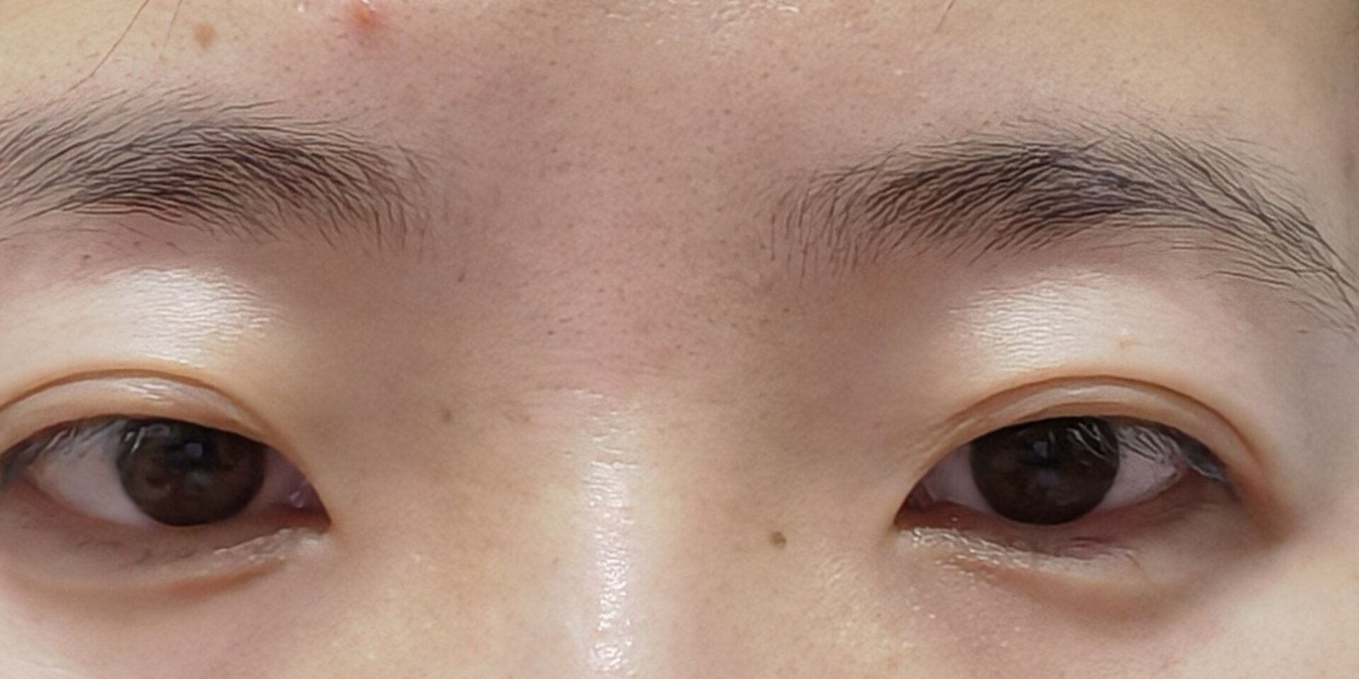 眼板腺囊肿 1,囊肿已经有2个月了,看着外观一直没变大(图3),其实下