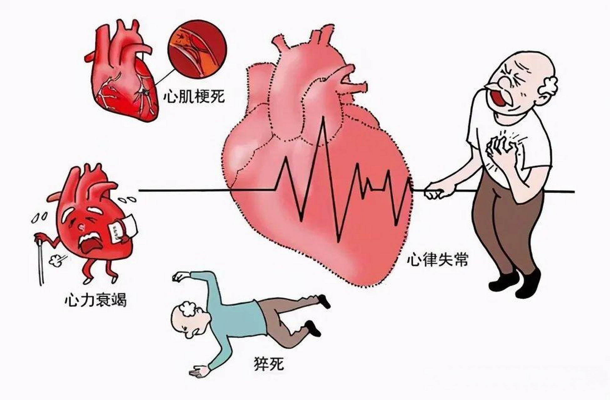 心肌梗死动漫图片图片