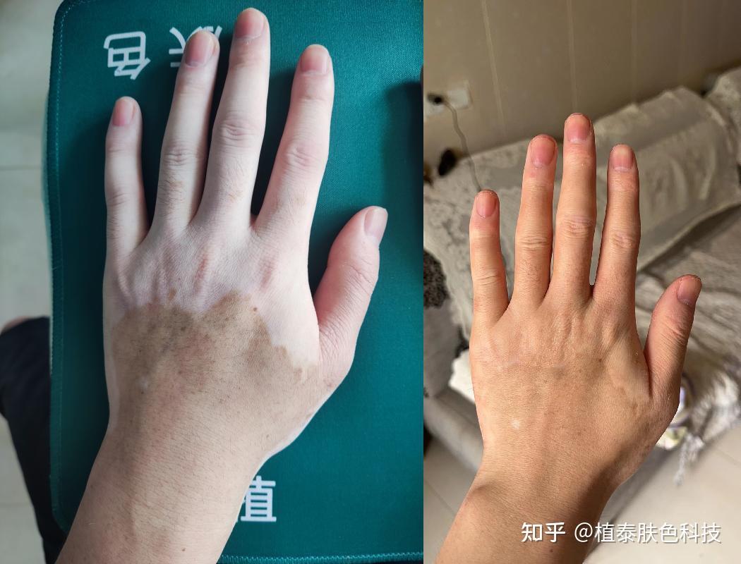 纹身纹肤色可以遮挡白色疤痕吗