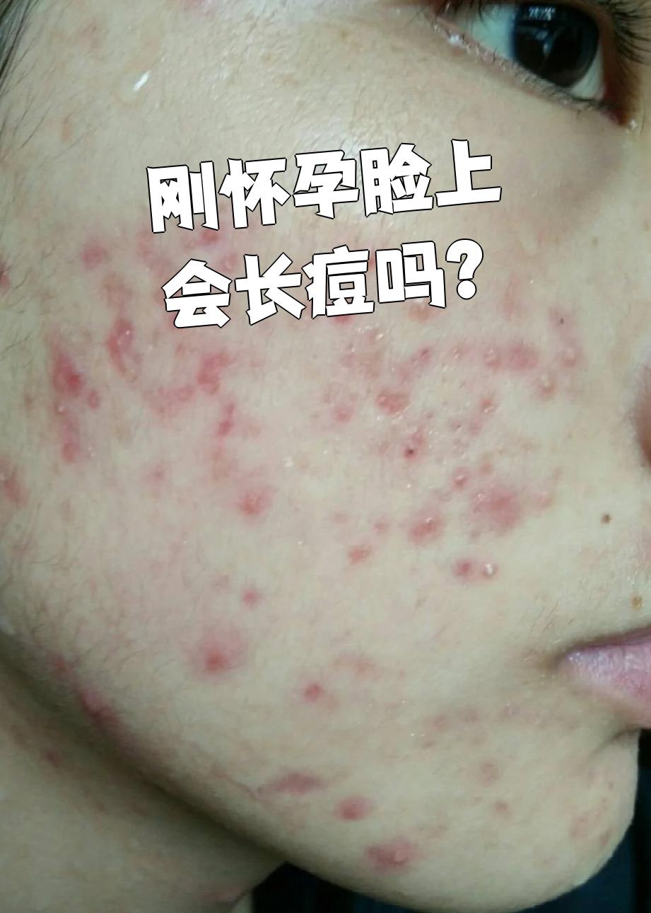 人为什么会长痘痘,如何预防长痘,去痘印为什么在线 人为什么会长痘痘,如何预防长痘,去痘印为什么在线
