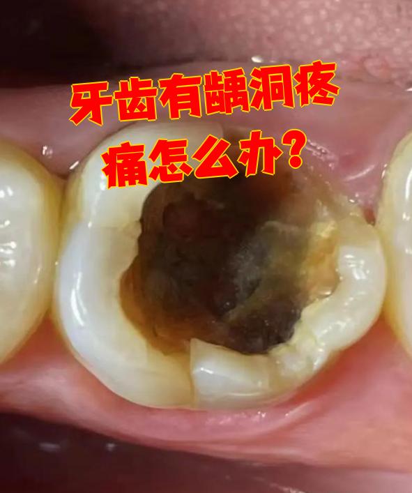 牙齿有龋洞疼痛时,可能是龋洞太深伤到牙神经引起了牙髓炎