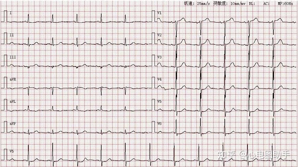 左房增大心电图图片