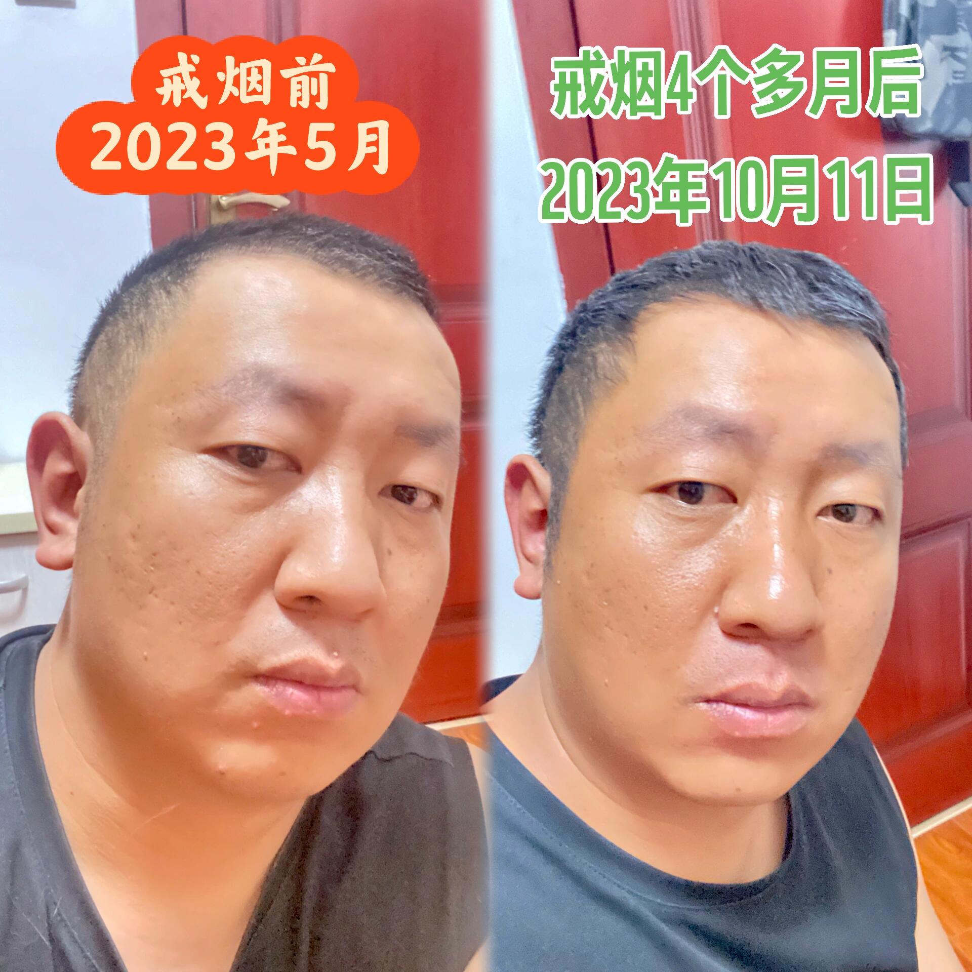 戒烟4个多月后!皮肤的变化