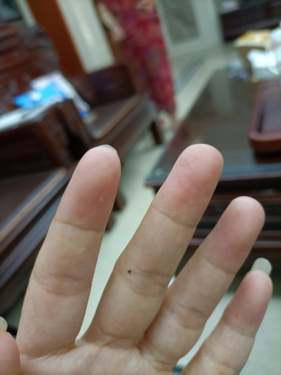 左手中指忽然长痣了