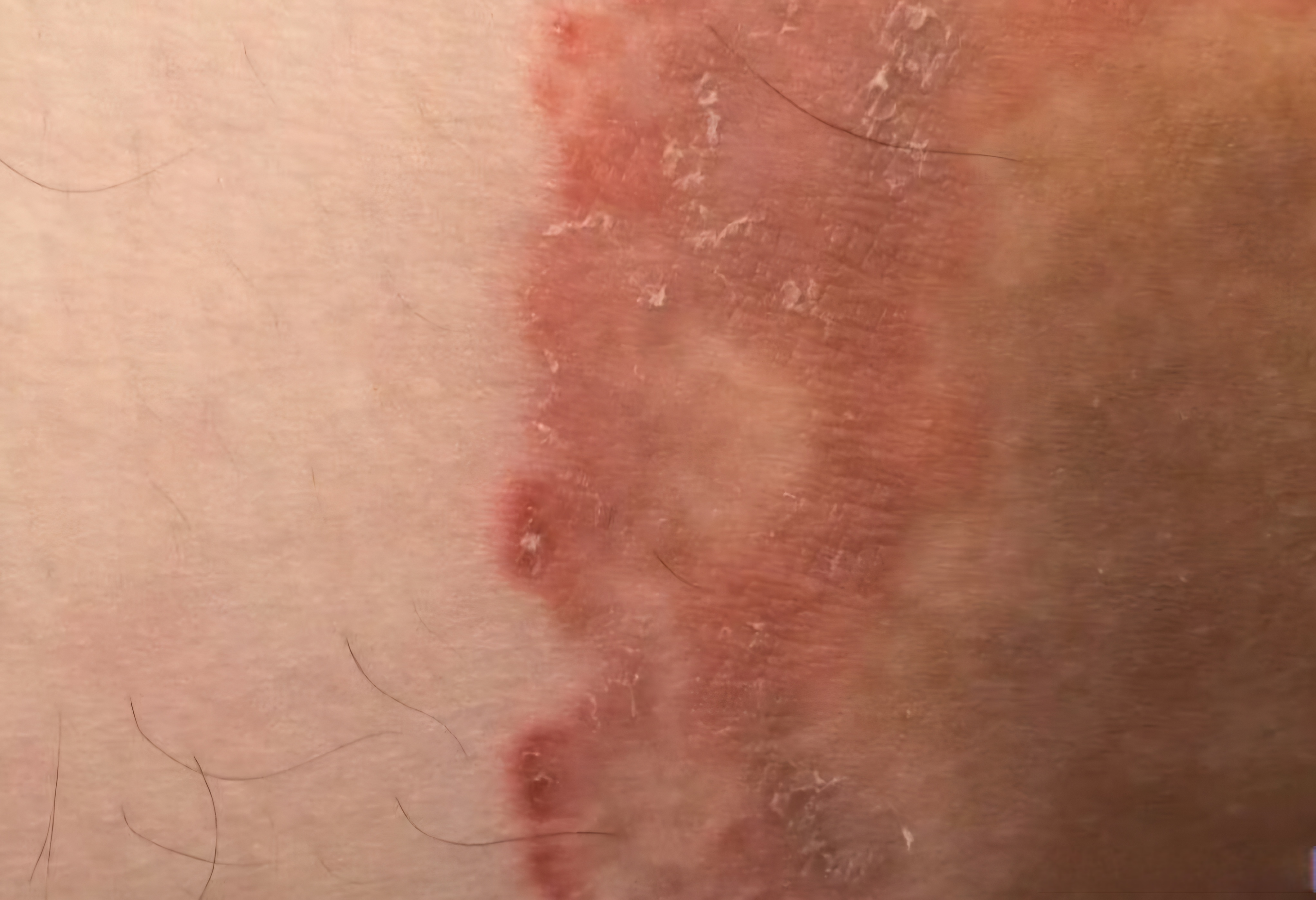 微博兴趣创作计划# #皮肤难题帮帮忙# 大腿根部的真菌感染