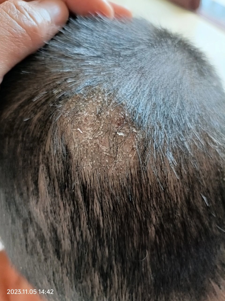 我儿子最近不知道去哪里感染了头皮癣,挺严重的,然后药膏也用了蛮多种