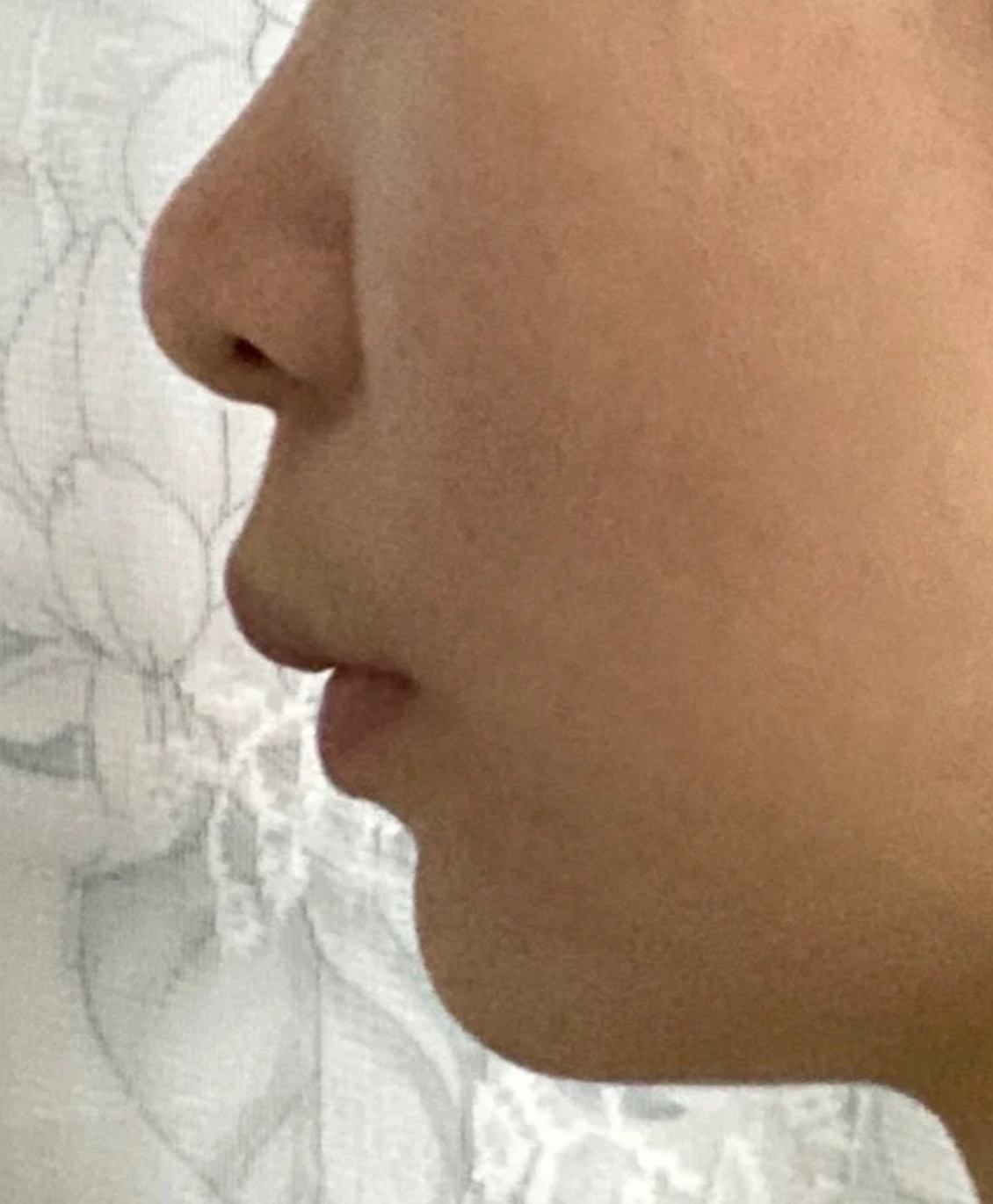 侧面看脸凸出来常见原因是牙齿排列不齐或嘴巴突出