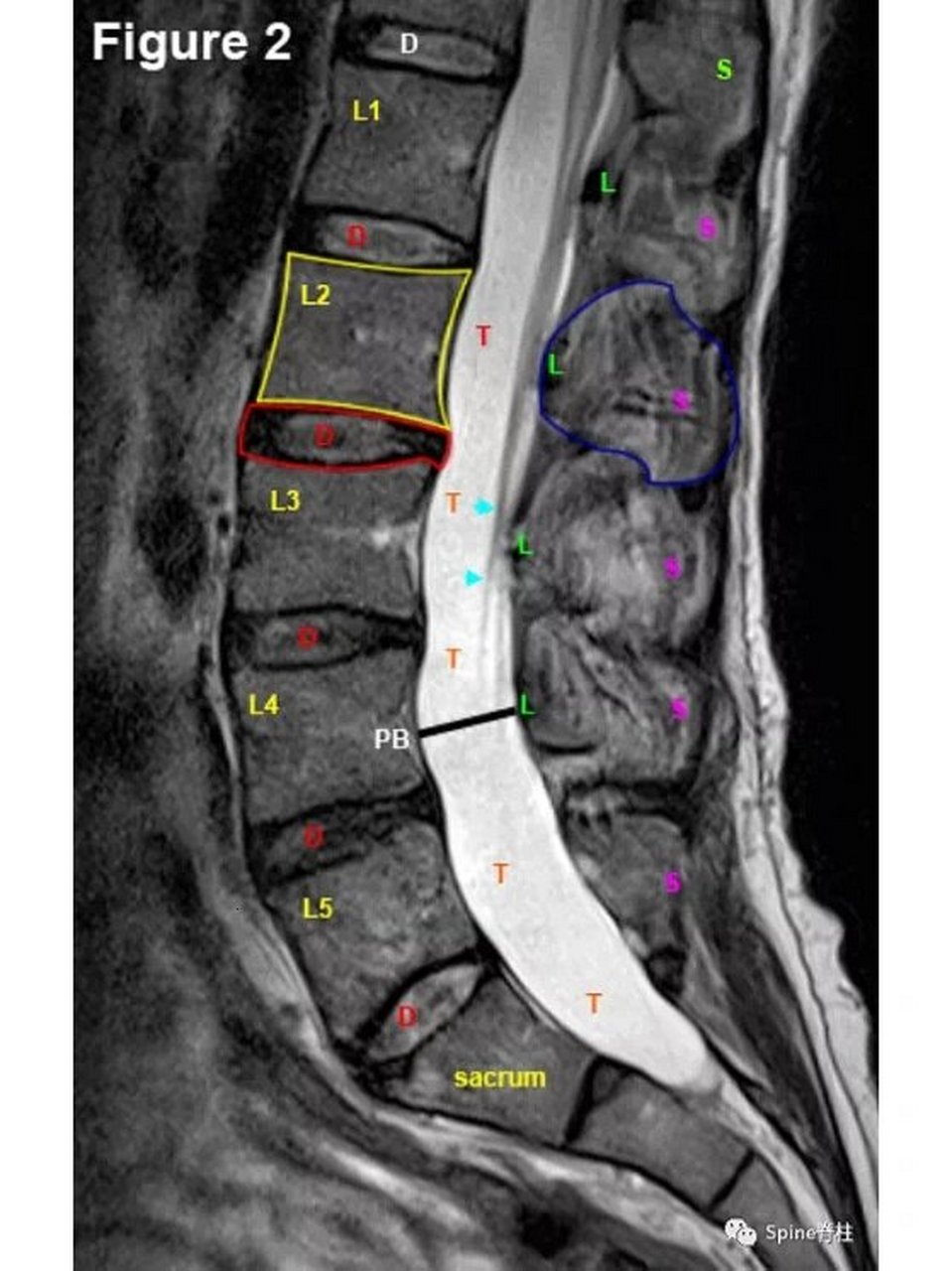 腰椎mri(核磁共振)依次mri:正中位,旁 腰椎mri(核磁共振) 依次mri