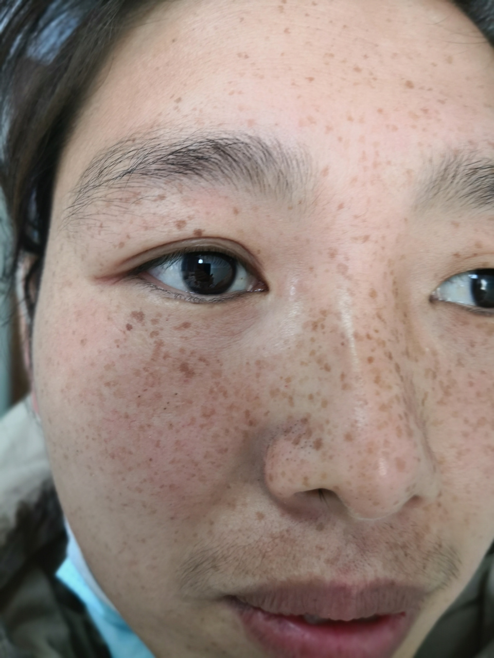 雀斑治疗前后对比图#美容##雀斑