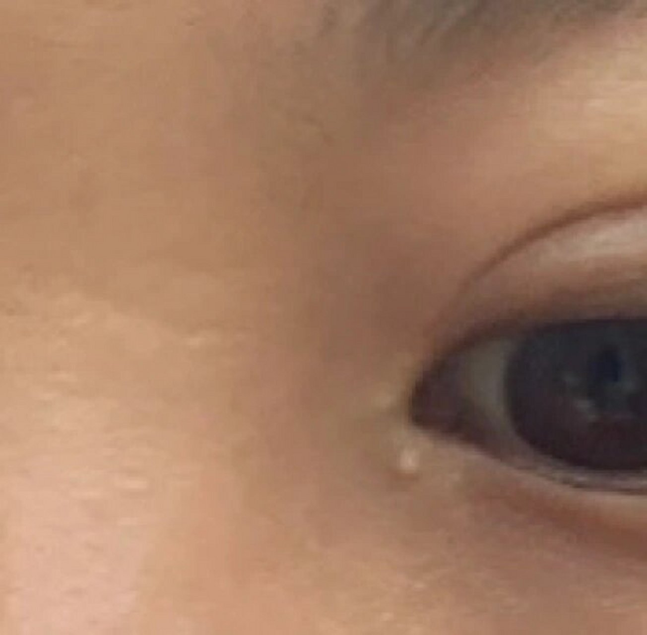 眼角小疙瘩94 最近半年发现眼角长了个小疙瘩 看起来像眼shi93 在