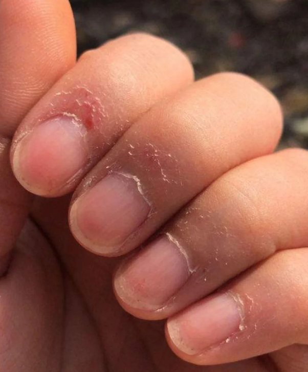 手上长倒刺很常见,主要有三个原因:摩擦过度,微量元素缺乏和营养