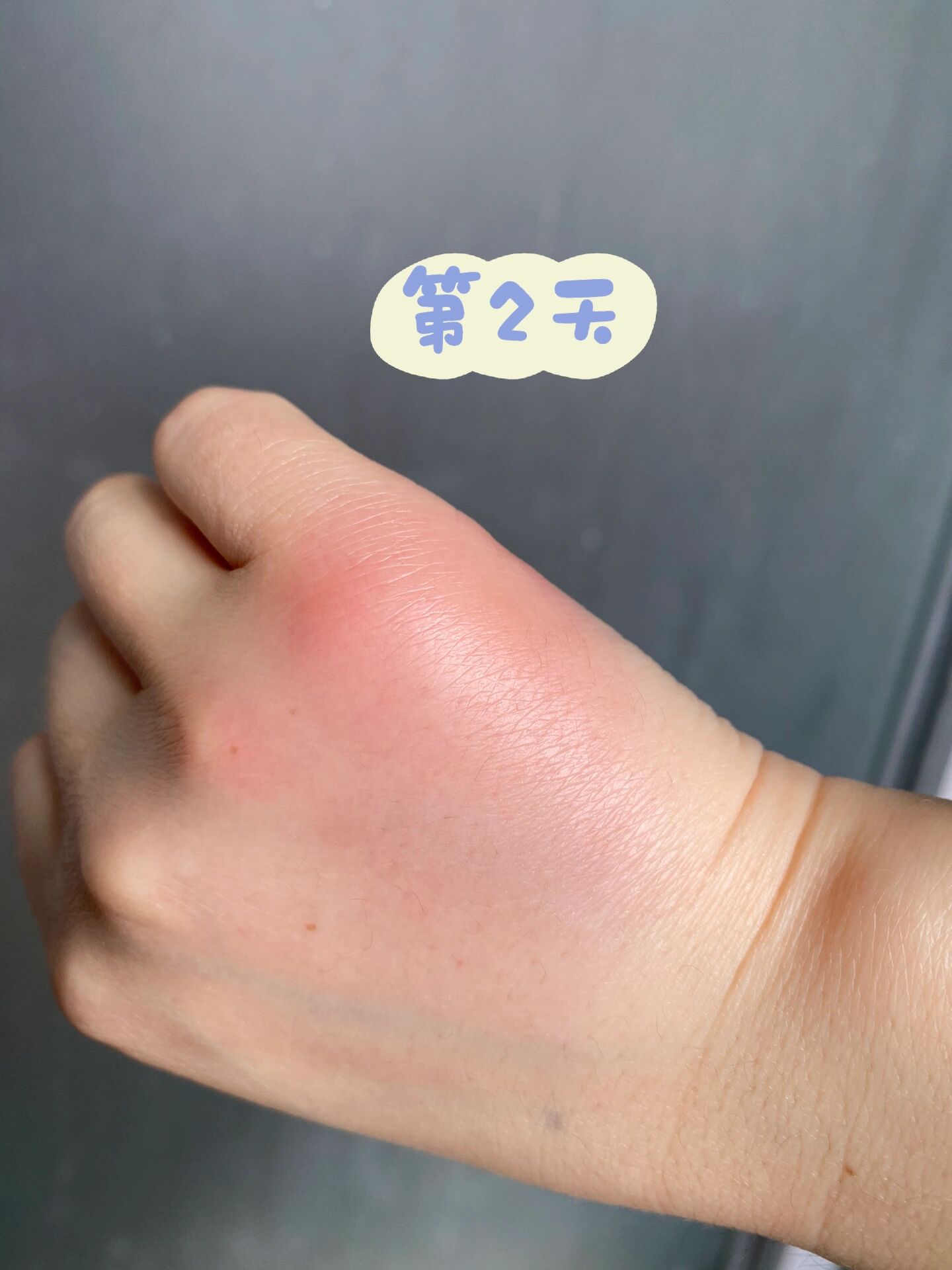 被会飞的蚂蚁🐜🦟咬了一口!太疼了😩