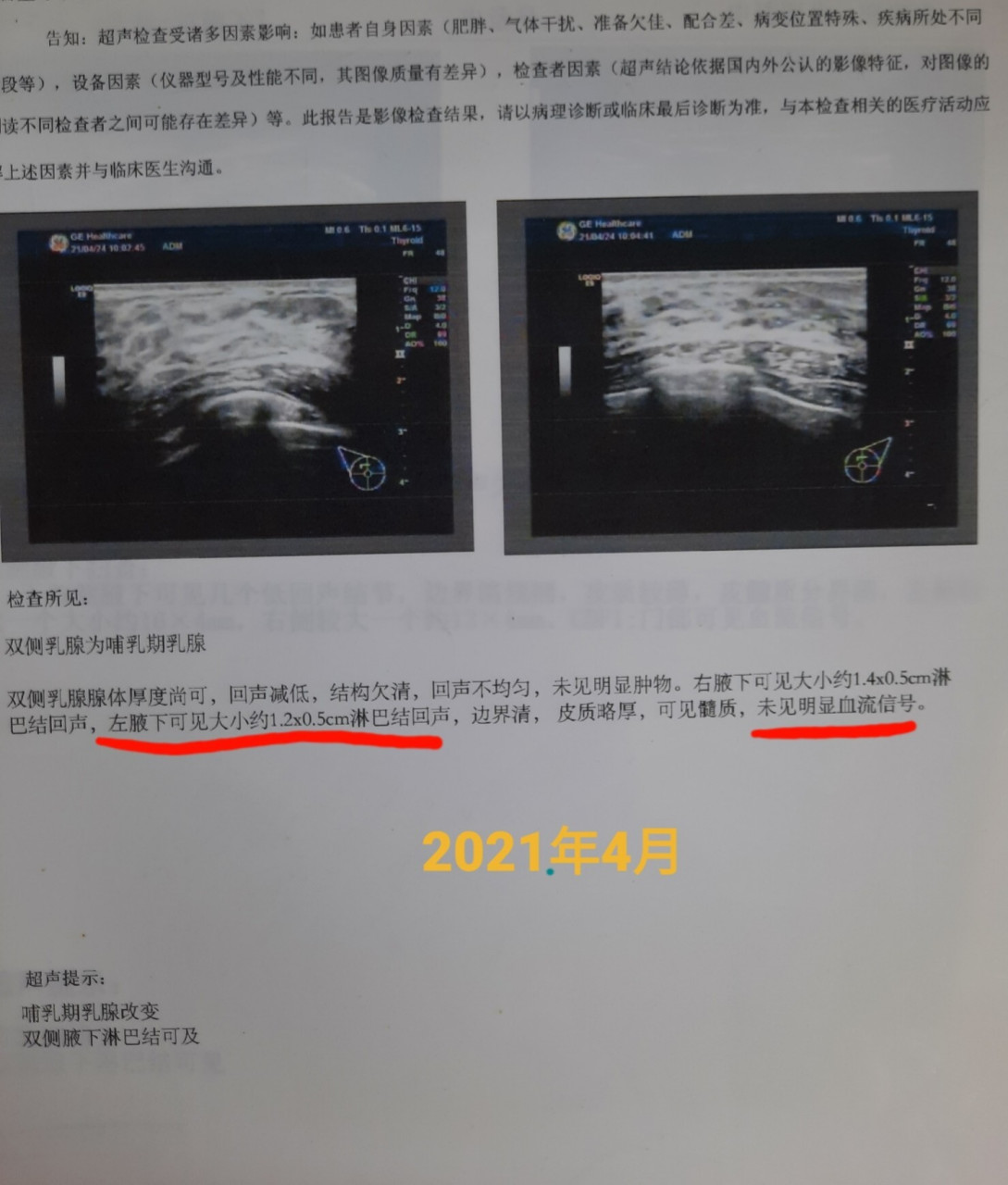 乳腺增生 双腋下淋巴结可见 可见血流信号 去年2021年4月 尚在哺乳期
