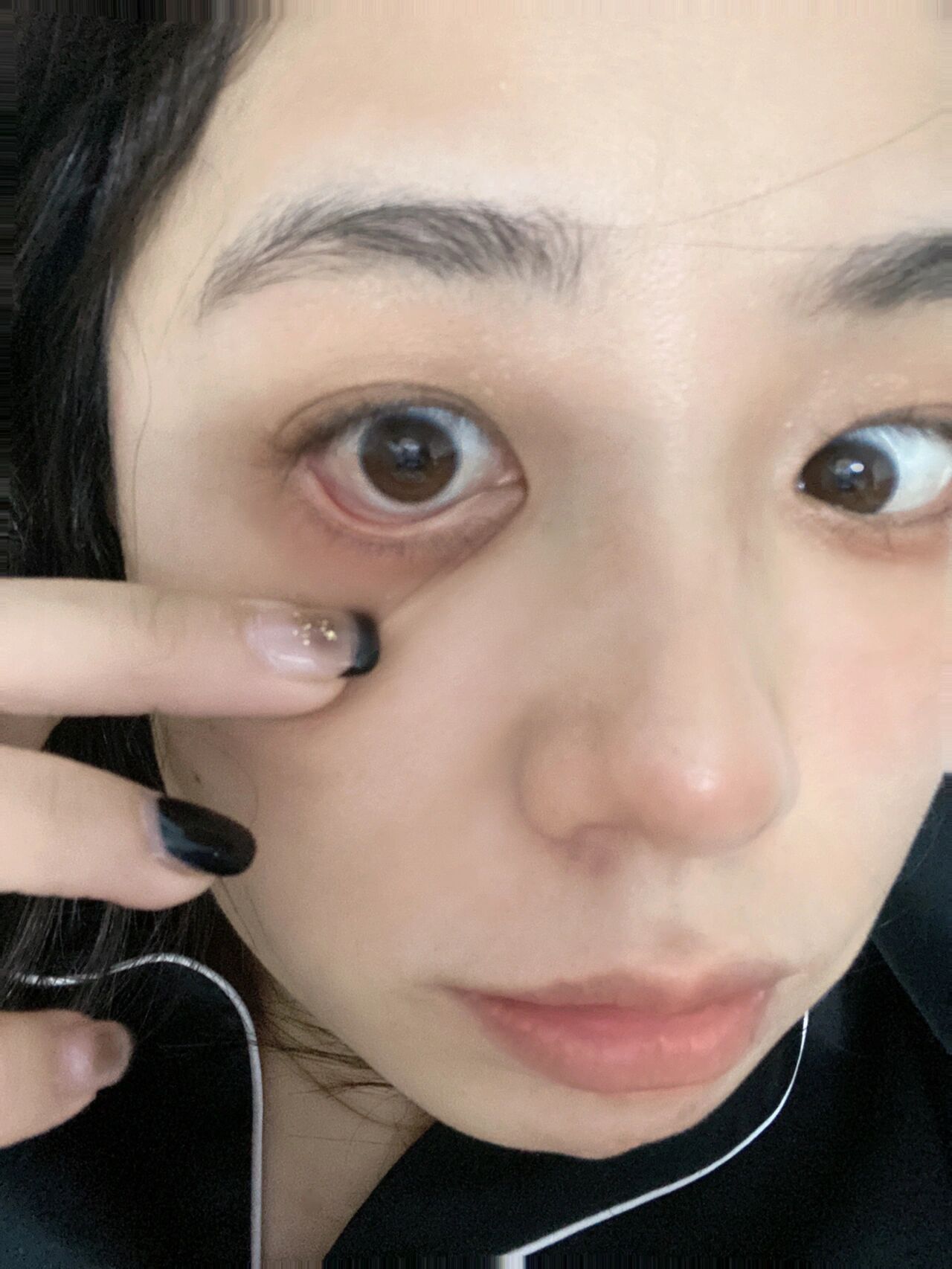 视网膜脱落 术后20 days