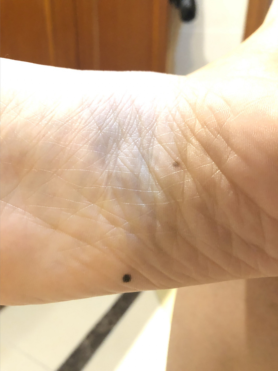 脚底板突然长痣 这颗痣应该是最近两三年长出来,感觉越来越黑,越来越