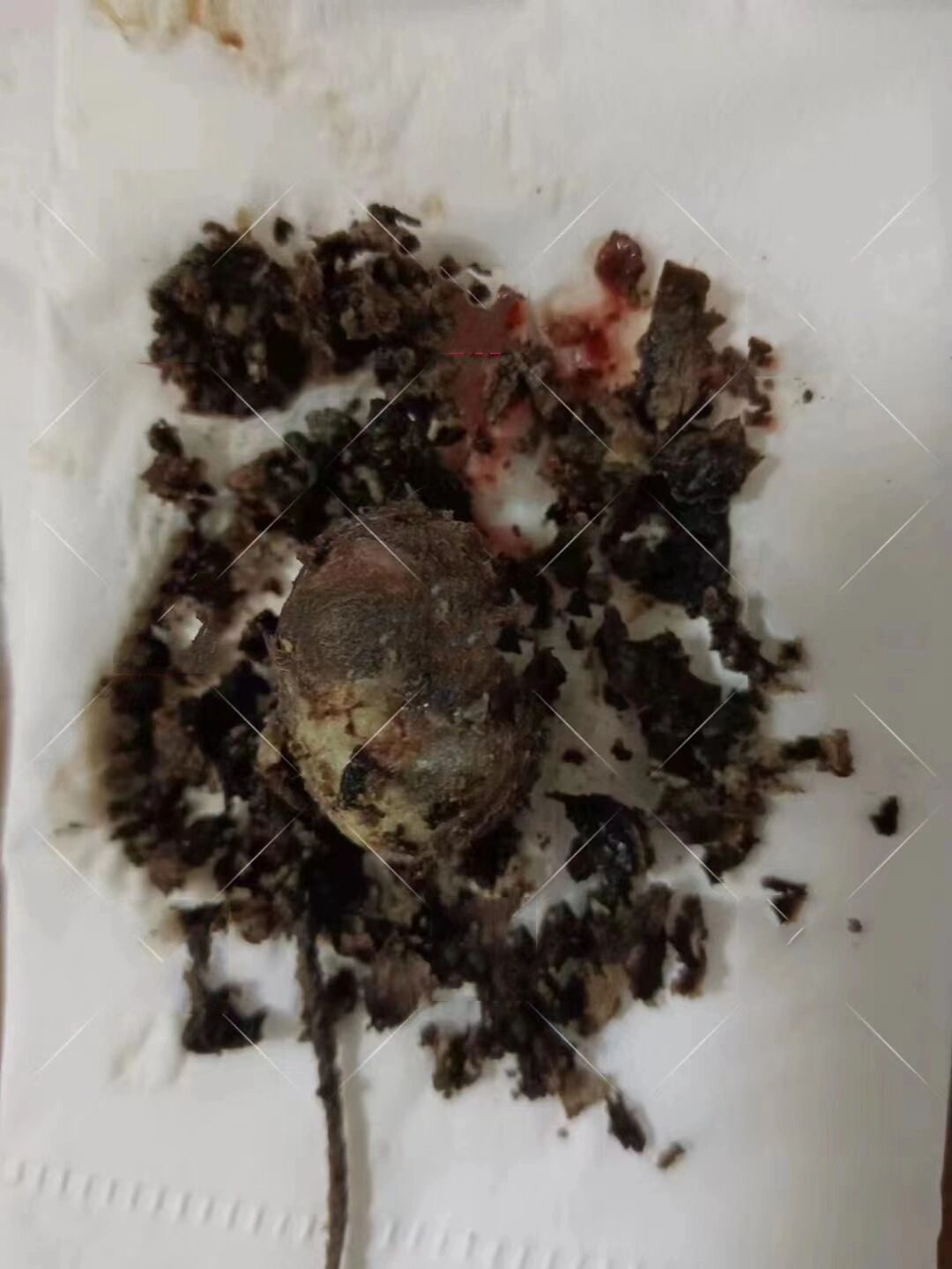 调理宫颈囊肿顾客 排出物一堆陈年垃圾,还有少许抗生素残留排出来,这