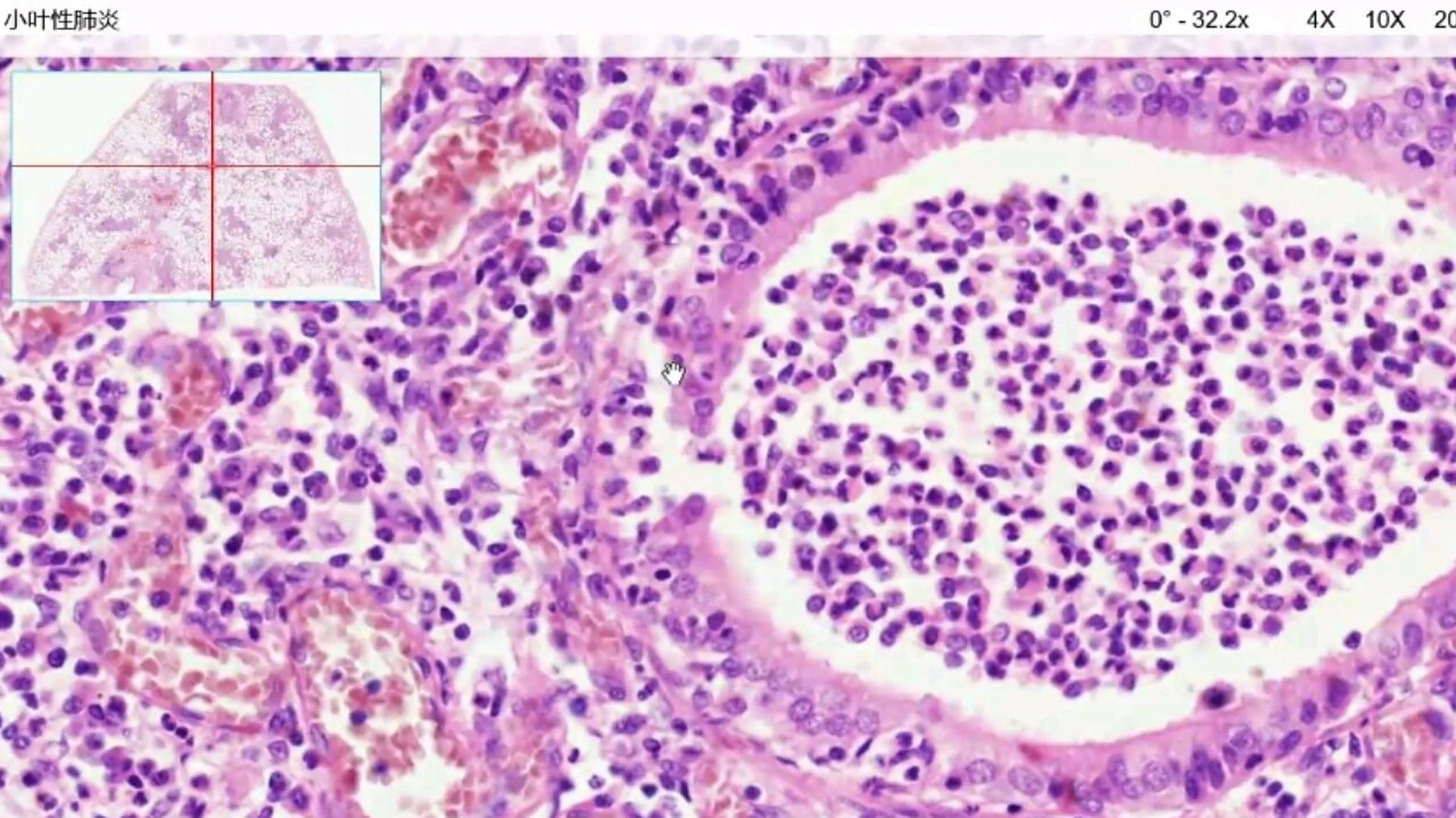 病理组织切片观察(七)呼吸,消化系统疾病 96实验结果: 166肺气肿