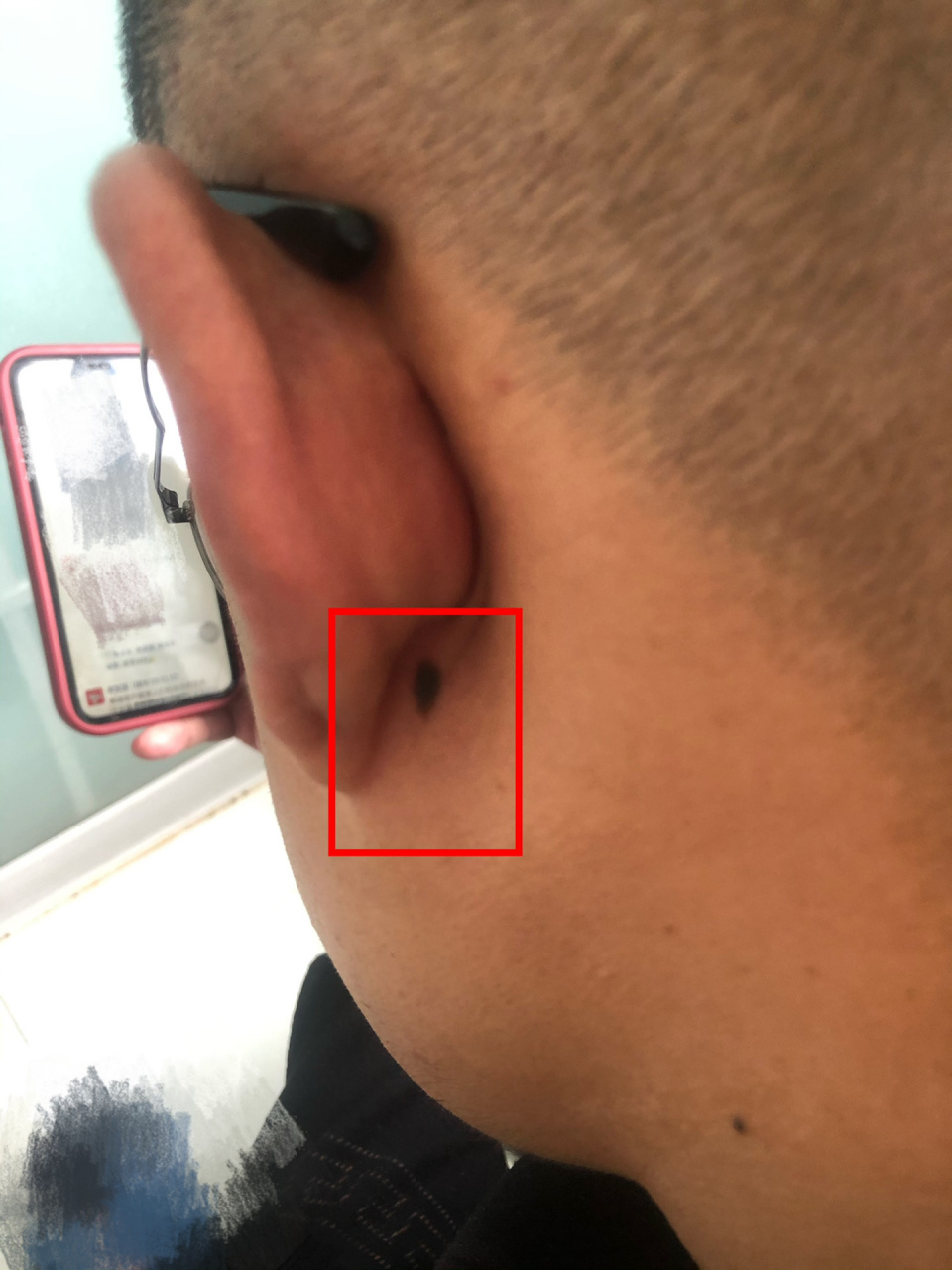 耳根痣相 大师们给看看,这个痣是不是不好,又黑又大