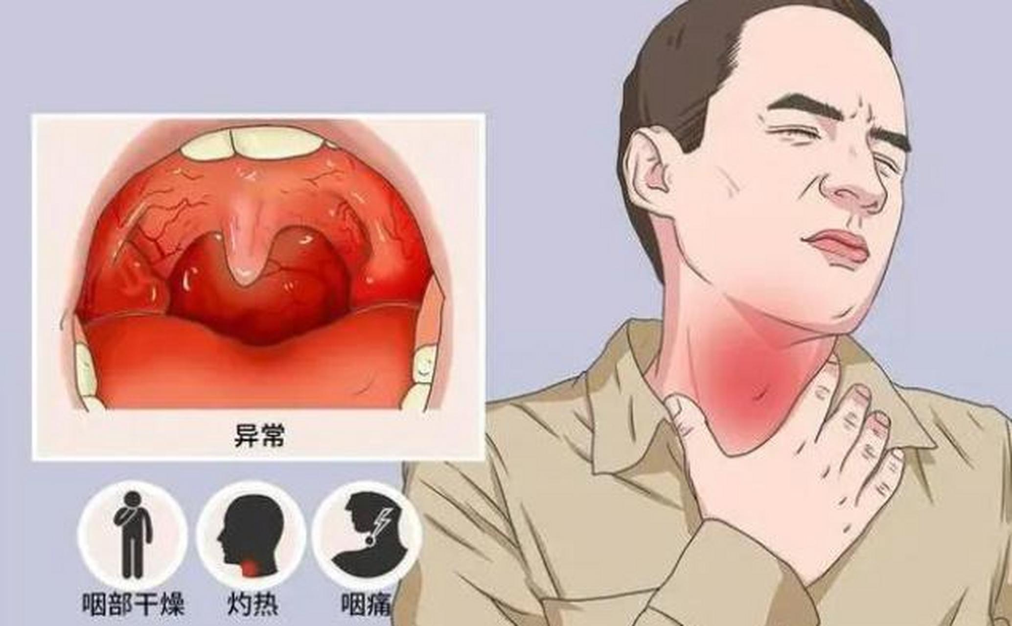 【如何区分咽炎和新冠感染】近期咽喉炎频发,很多人怀疑自己是不是"阳