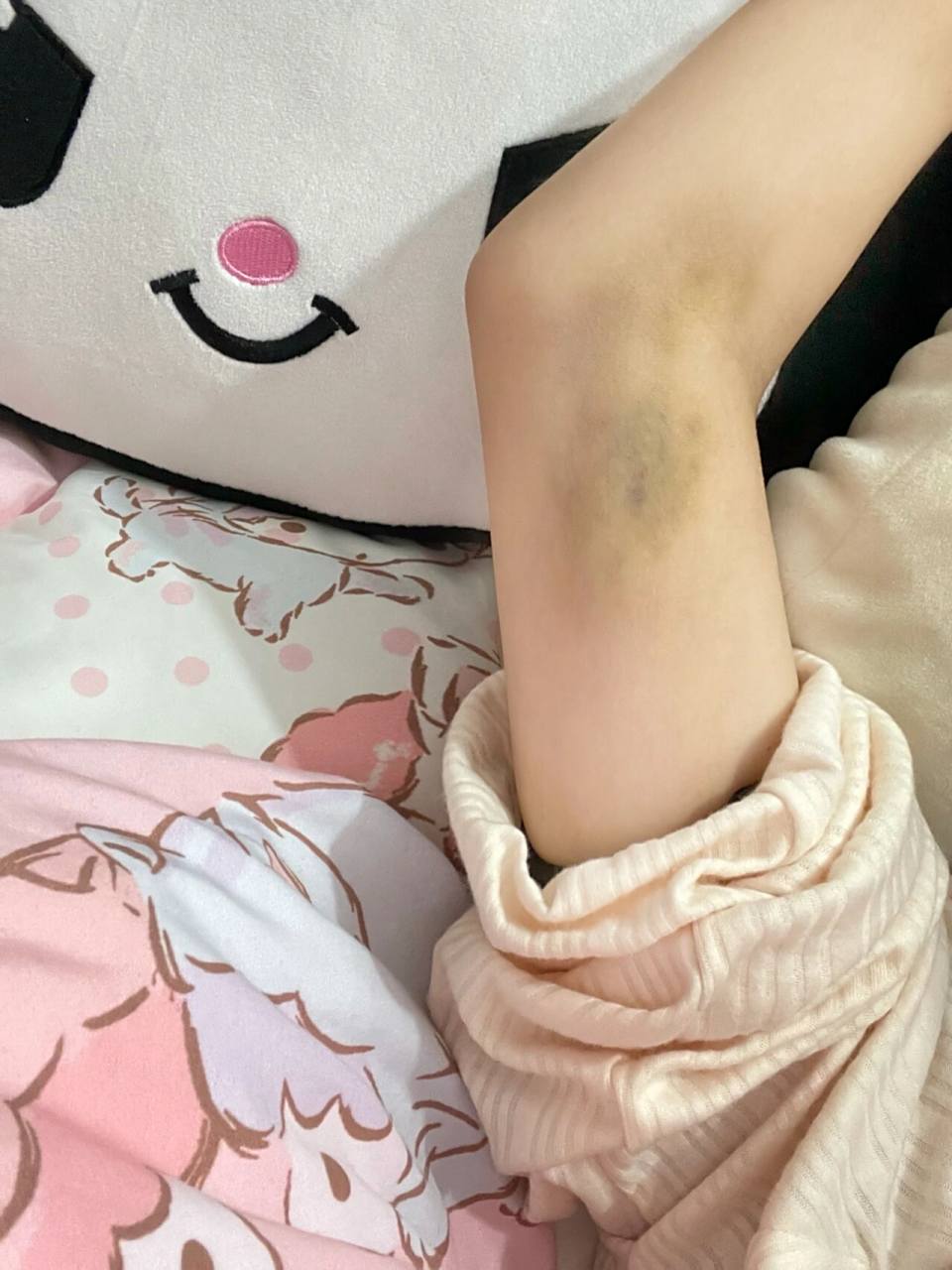 也不知道怎么伤的 我是真滴牛,每次撞的青一块紫一块我都不知道,这么