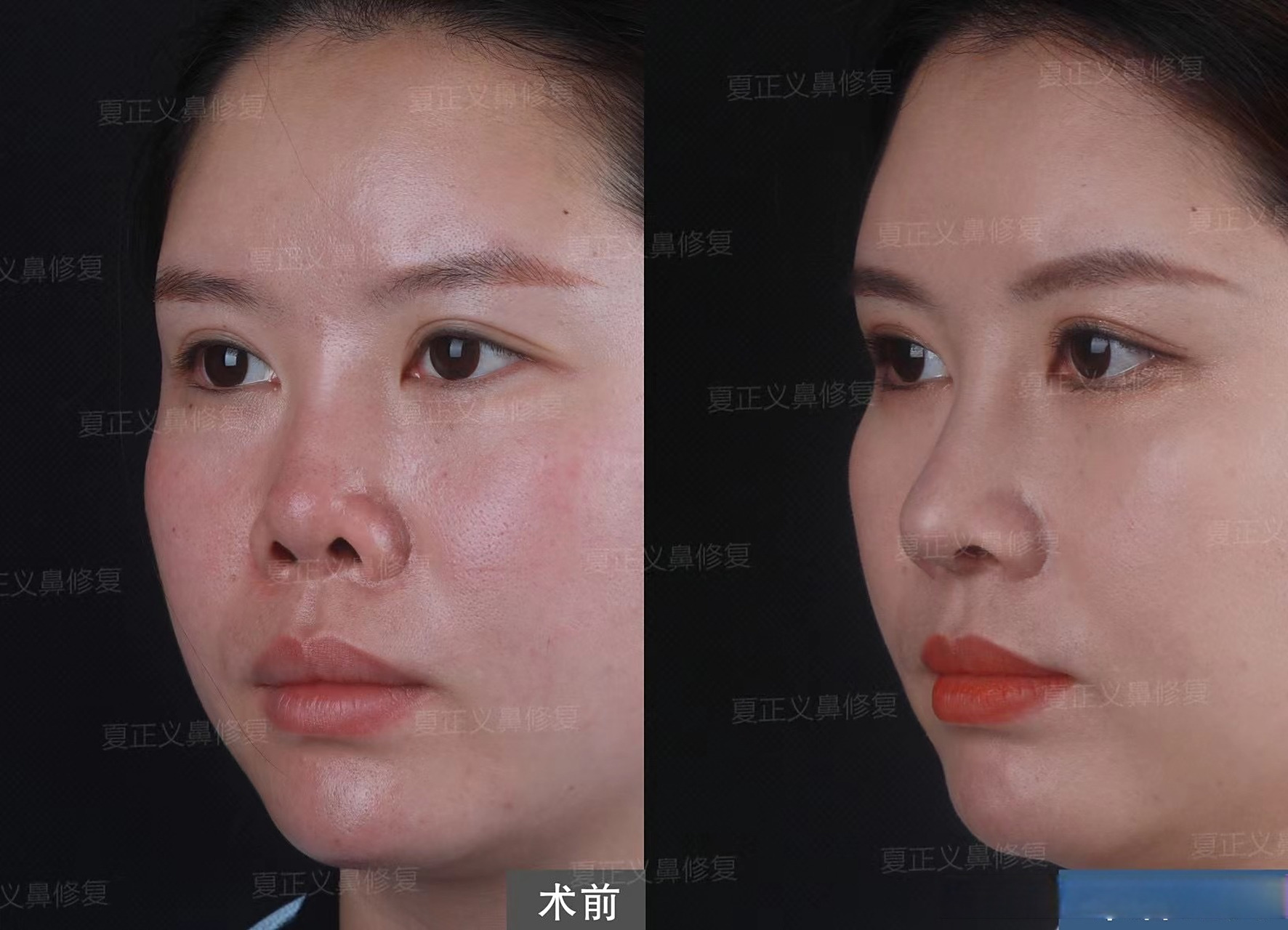 【挛缩鼻修复】 正面漏鼻孔,朝天短鼻,形态怪异,重新搭建鼻部结构