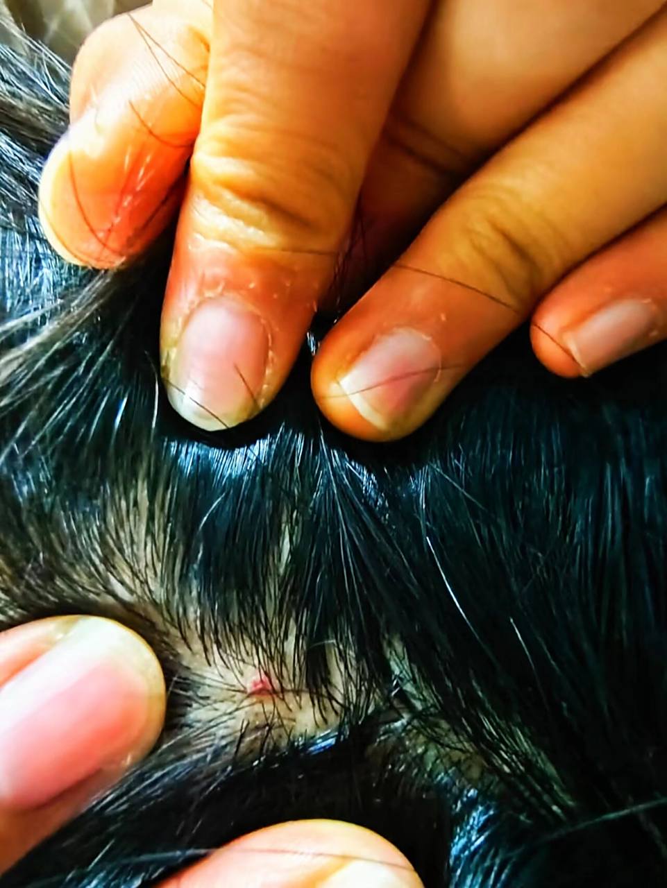 虱子 头虱 百部酊治疗无效