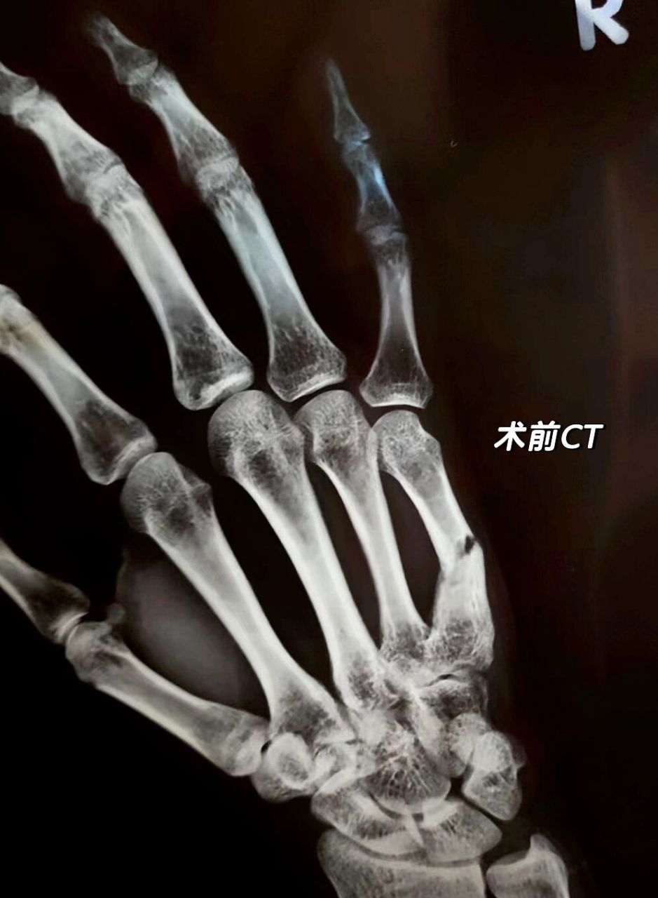 掌骨骨折|克氏钉手术经验分享 右手第五掌骨骨折,进行了克氏钉固定术