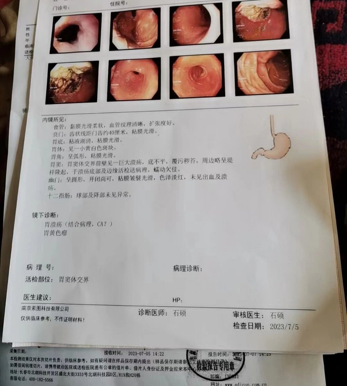 胃体小弯低分化腺癌图片