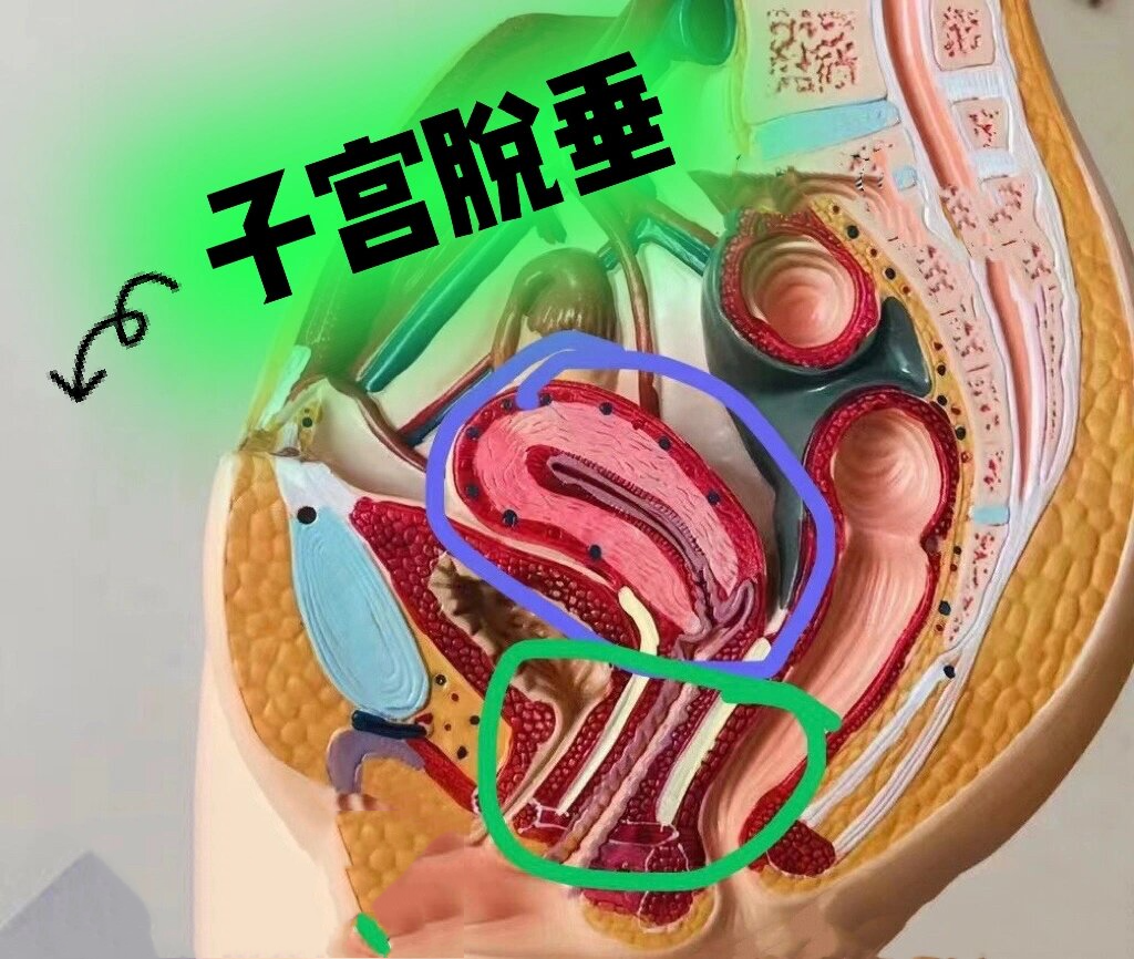 日常艾灸案例分析之子宫脱垂