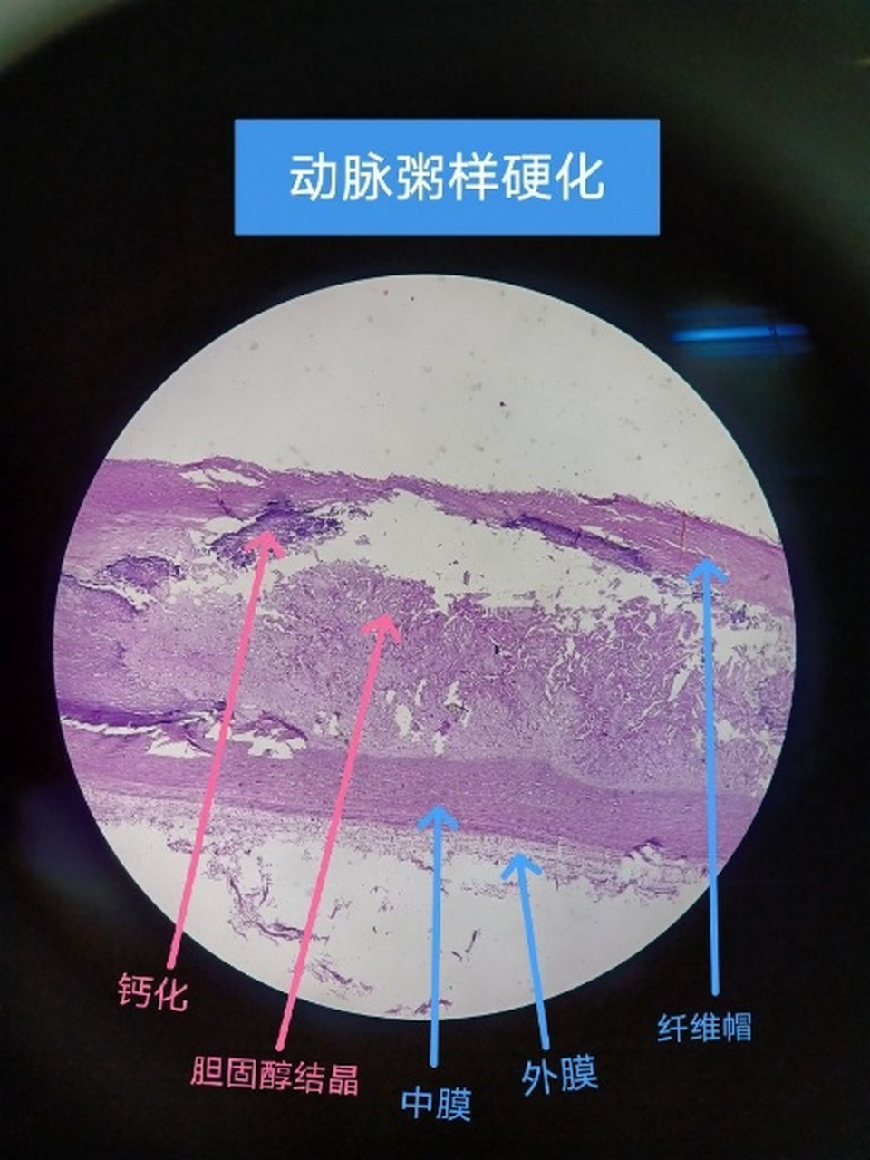 风湿性心肌炎病理图片