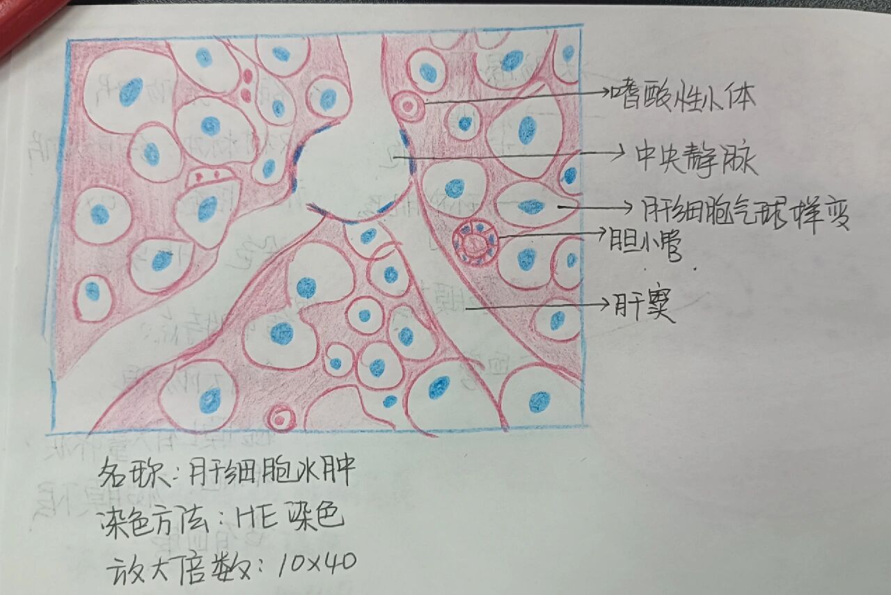 病理红蓝笔绘画图:肝细胞水肿