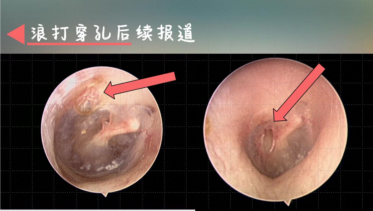 鼓膜充血图片图片