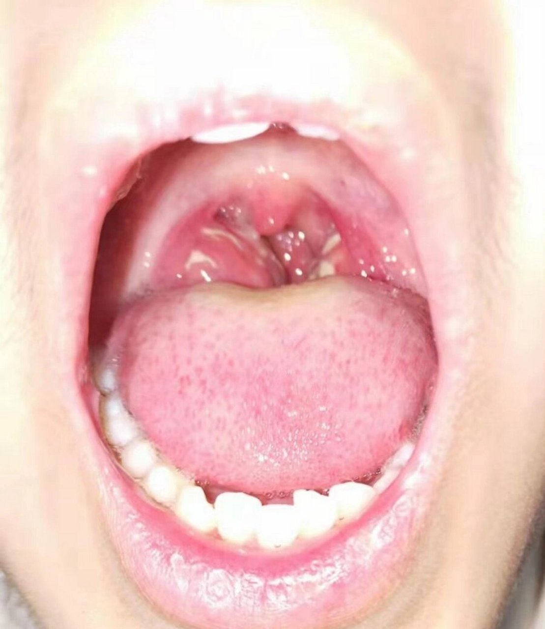 小儿扁桃体肿大怎么回事?