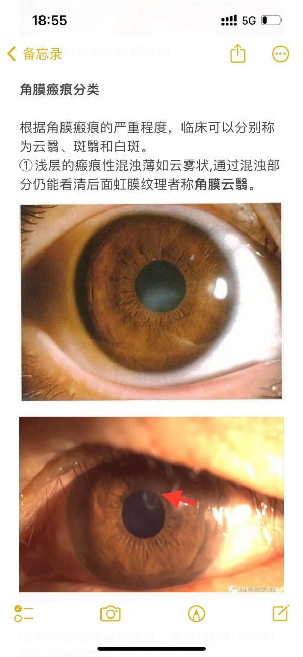 裂隙灯下的角膜损伤及瘢痕分类0690 裂隙灯下看到角膜有损伤,瘢痕