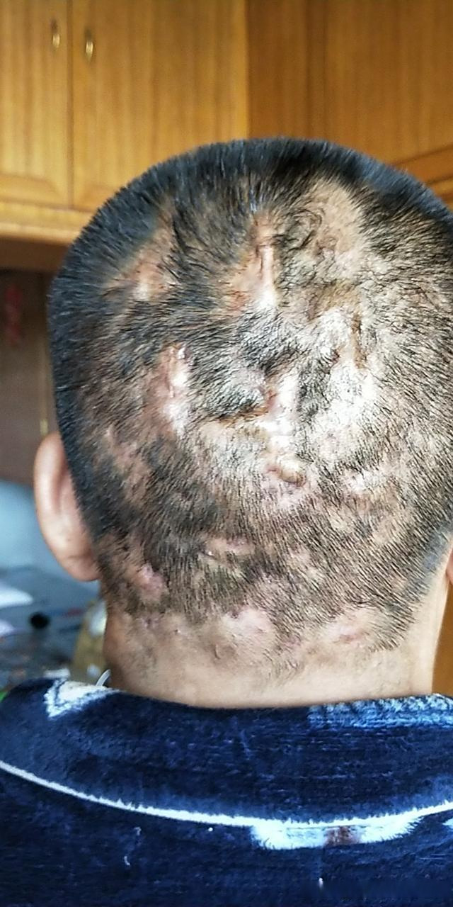 门诊有位男患者,30多岁,头上老是起大脓肿,疼得要命,晚上都睡不好觉