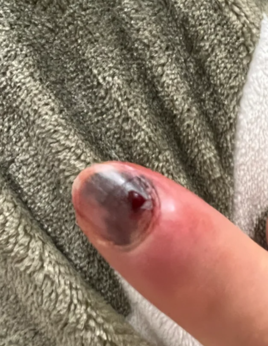 指甲被砸伤后出现淤血,多久能好要看具体情况