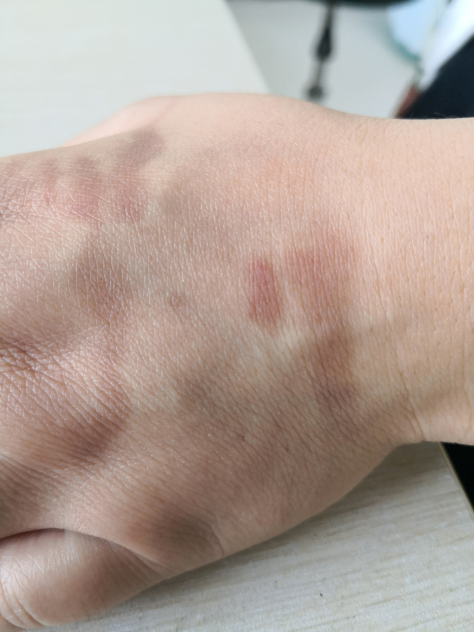 手背无诱因出现的条形黄褐色色素斑片.